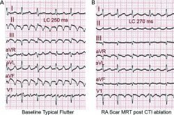 atrial flutter symptoms atrial flutter symptoms