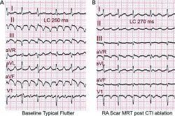 Atrial flutter ec