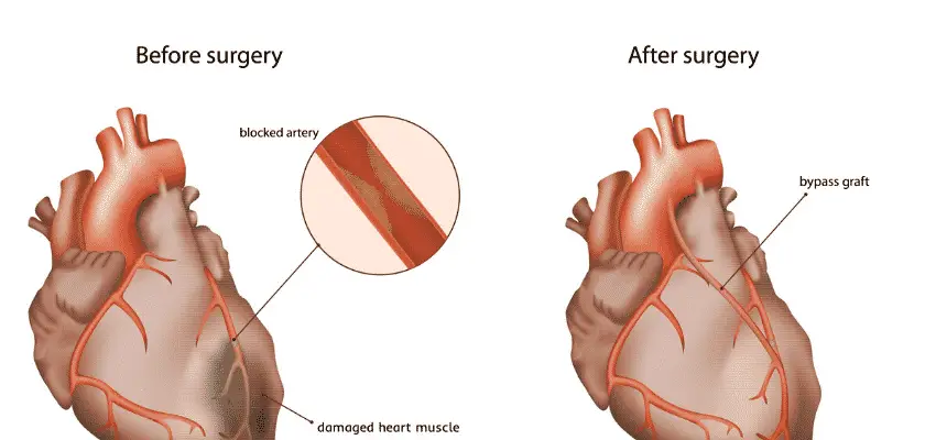 Coronary artery disease signs and symptoms