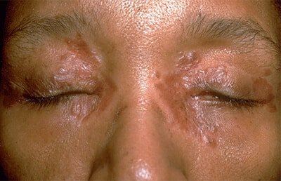 Skin sarcoidosis