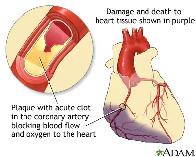 Widowmaker heart attack facts