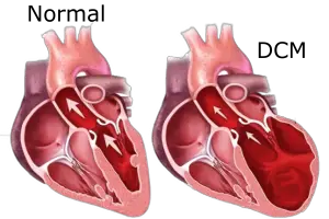 Common causes of congestive heart failure