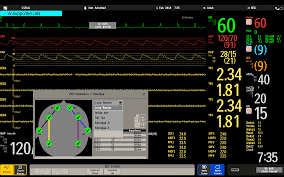 Continuous EKG monitoring in COVID patients.