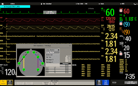 Continuous EKG monitoring in COVID patients. Continuous EKG monitoring in COVID patients.