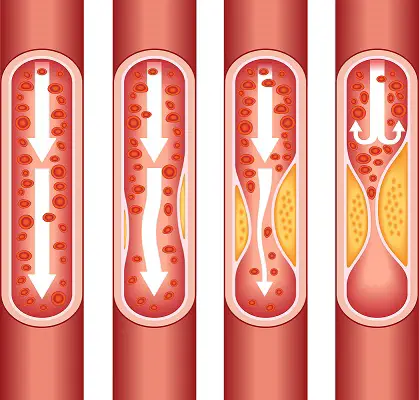 re sock marks a sign of heart disease