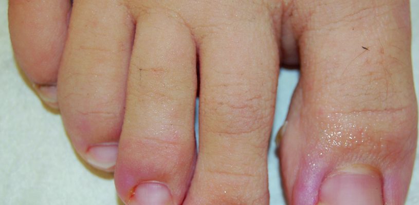 An ingrown toenail is not a sign of heart disease. Heart disease is any disorder that affects the heart