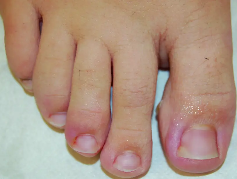An ingrown toenail is not a sign of heart disease. Heart disease is any disorder that affects the heart