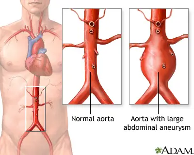 Why is an Angioplasty an Incorrect Treatment for an Aneurysm?