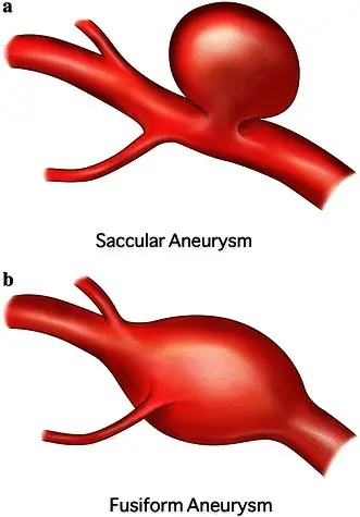 Why is an Angioplasty an Incorrect Treatment for an Aneurysm?