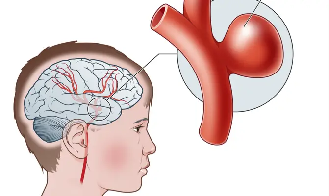 why is an angioplasty an incorrect treatment for an aneurysm