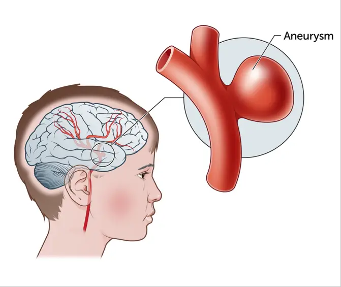 why is an angioplasty an incorrect treatment for an aneurysm