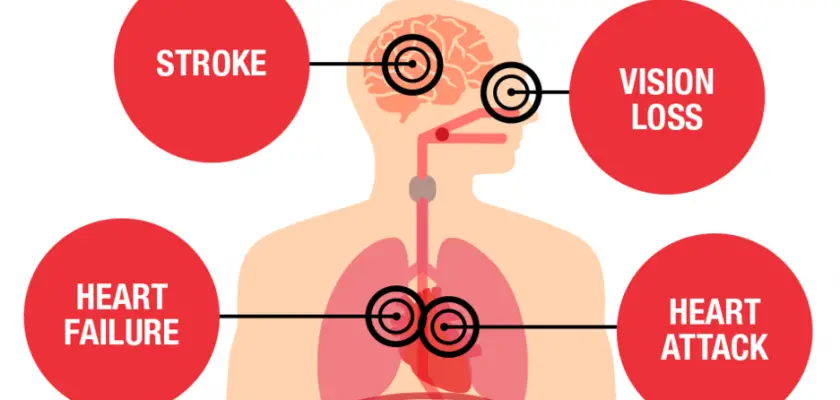 Complications of high blood pressure