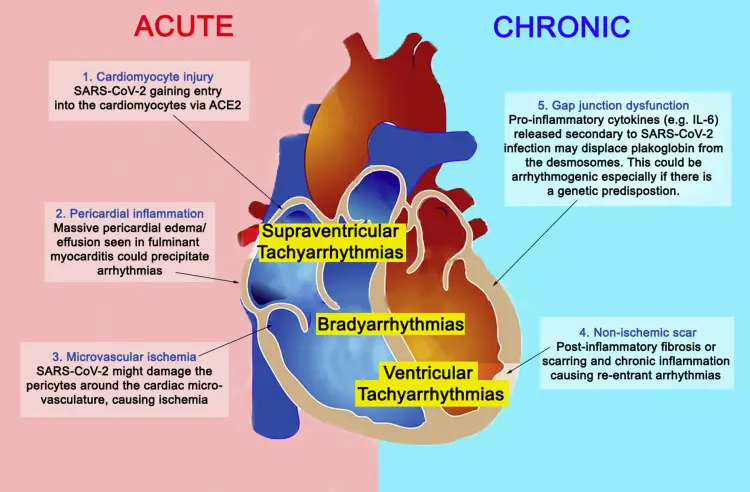 COVID 19 AND MYOCARDITIS