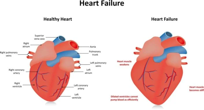 chf healed, congestive heart failure cured