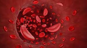 Sickle cell anemia is a genetic blood disorder that affects millions of people worldwide. It is a type of sickle cell disease (SCD) that is caused by a mutation in the HBB gene that encodes for hemoglobin, a protein found in red blood cells that carries oxygen throughout the body.
