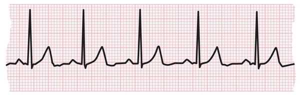 Ekg. An electrocardiogram (EKG or ECG) is a non-invasive, diagnostic test that measures the electrical activity of the heart. It's used to assess the heart's rhythm and the conduction of electrical impulses through the heart muscle. This is typically done by placing electrodes on the patient's chest, arms, and legs.