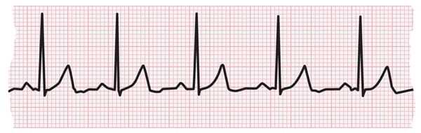 Ekg. An electrocardiogram (EKG or ECG) is a non-invasive, diagnostic test that measures the electrical activity of the heart. It's used to assess the heart's rhythm and the conduction of electrical impulses through the heart muscle. This is typically done by placing electrodes on the patient's chest, arms, and legs.