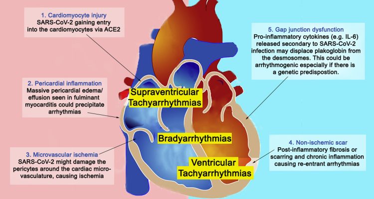 Myocarditis is a medical condition that occurs when there is inflammation in the heart muscle. This inflammation can weaken the heart and cause it to work less efficiently. Myocarditis can be caused by a viral infection, bacterial infection, or an autoimmune condition. The symptoms of myocarditis can range from mild to severe, and can include chest pain, shortness of breath, and fatigue. In this article, we will discuss how myocarditis is diagnosed and treated.