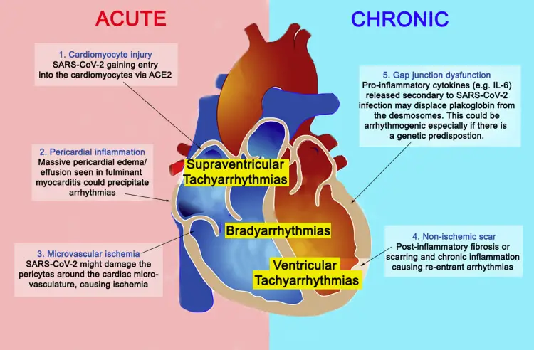 Myocarditis is a medical condition that occurs when there is inflammation in the heart muscle. This inflammation can weaken the heart and cause it to work less efficiently. Myocarditis can be caused by a viral infection, bacterial infection, or an autoimmune condition. The symptoms of myocarditis can range from mild to severe, and can include chest pain, shortness of breath, and fatigue. In this article, we will discuss how myocarditis is diagnosed and treated.