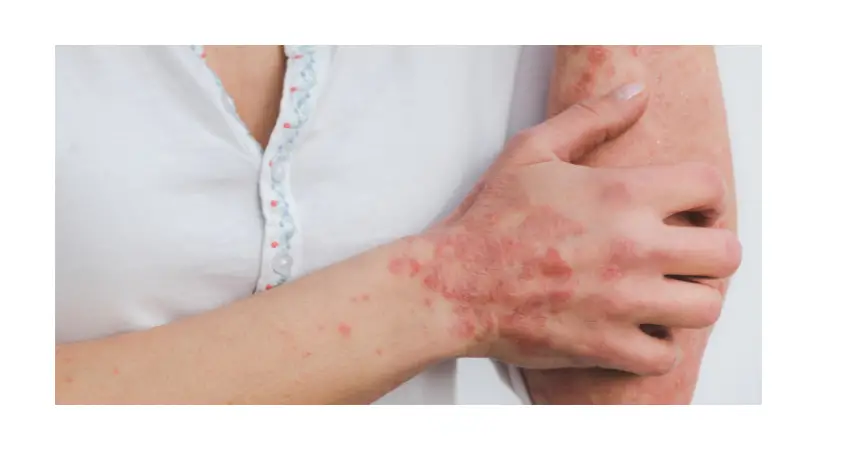 The prevalence of psoriasis and high blood pressure