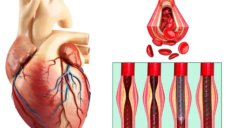 Cardiac stents in South Africa