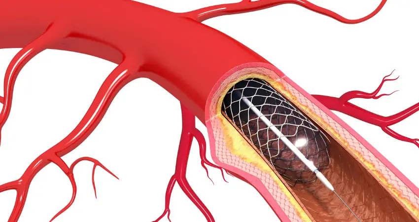 Heart Stents in South Africa