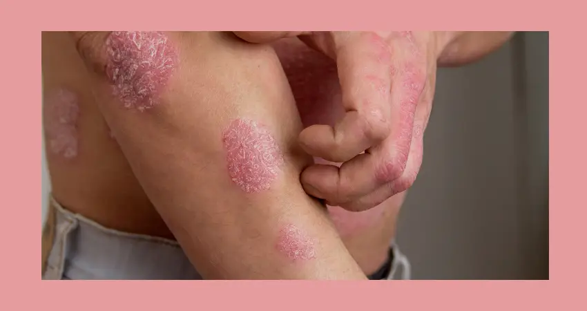 Psoriasis and high blood pressdure