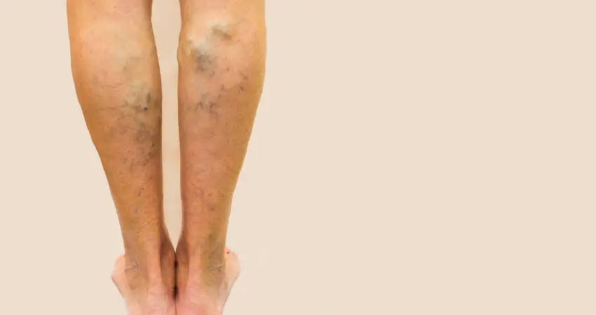 Nurses and Varicose Veins