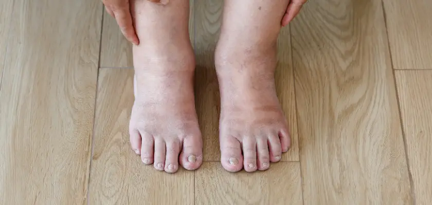Pictures of swollen ankles due to congestive heart failure