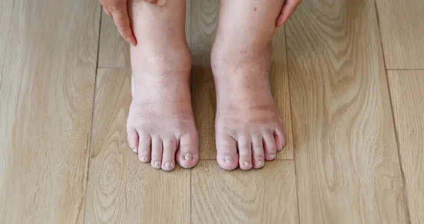 Pictures of Swollen Feet and Ankles  Causes, treatments
