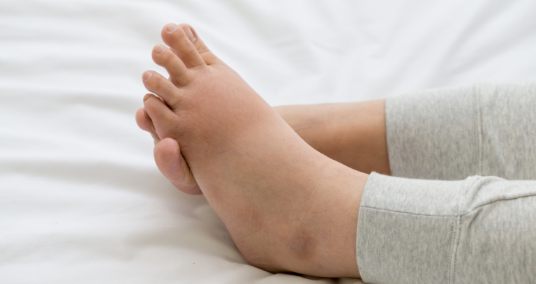 Pictures Of Swollen Ankles Due To Congestive Heart Failure