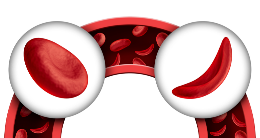Sickle cell and pain management