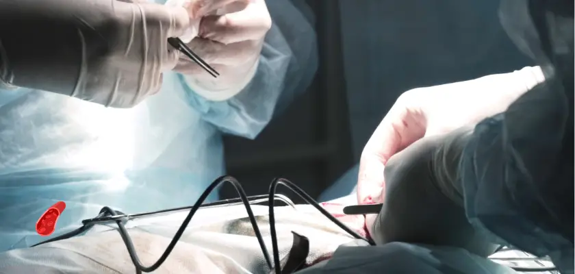 Understanding Embolectomy: A Patient's Guide to Blood Clot Removal